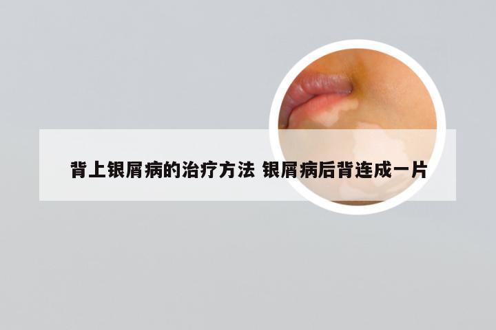 背上银屑病的治疗方法 银屑病后背连成一片