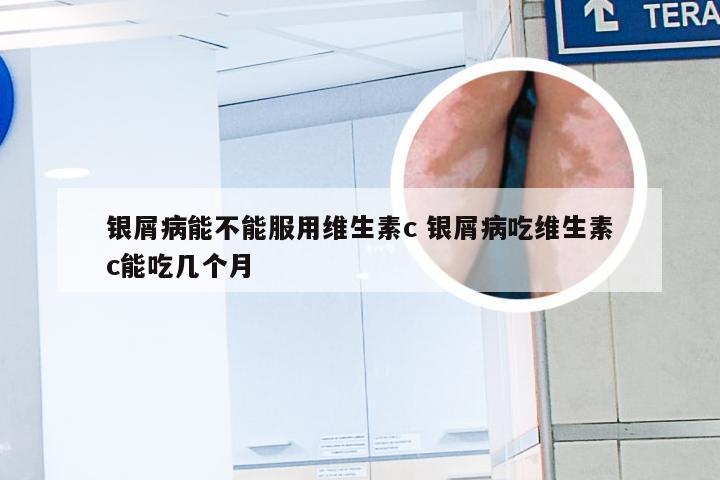 银屑病能不能服用维生素c 银屑病吃维生素c能吃几个月