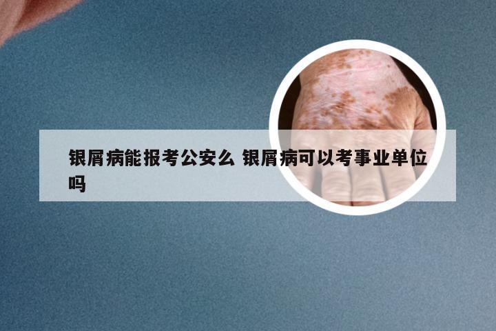 银屑病能报考公安么 银屑病可以考事业单位吗