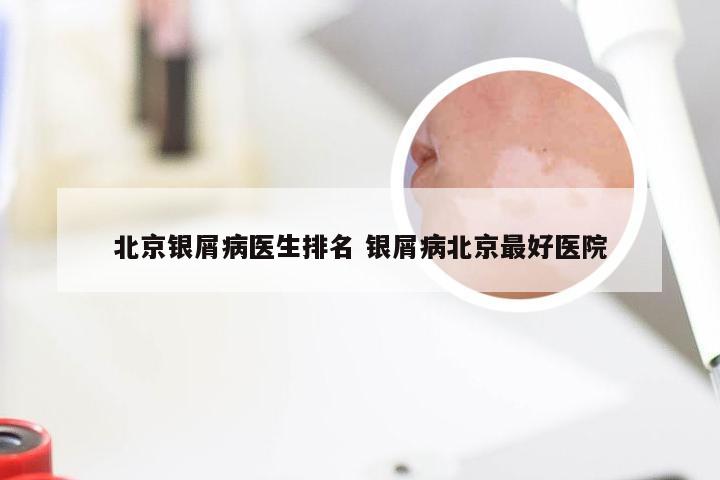 北京银屑病医生排名 银屑病北京最好医院