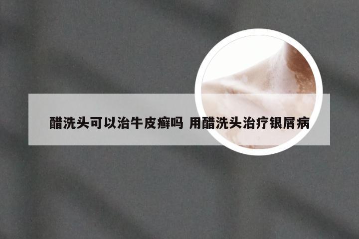 醋洗头可以治牛皮癣吗 用醋洗头治疗银屑病
