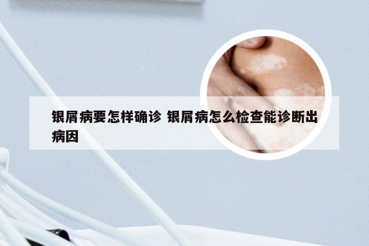 银屑病要怎样确诊 银屑病怎么检查能诊断出病因