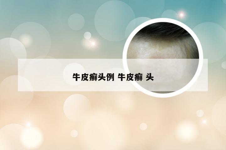 牛皮癣头例 牛皮癣 头