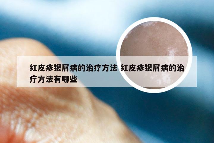 红皮疹银屑病的治疗方法 红皮疹银屑病的治疗方法有哪些