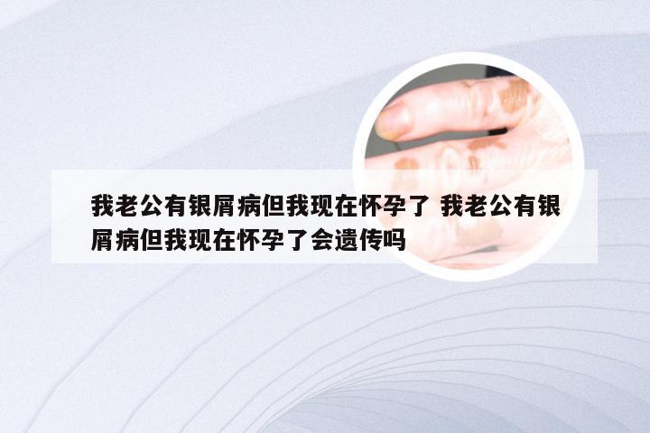 我老公有银屑病但我现在怀孕了 我老公有银屑病但我现在怀孕了会遗传吗