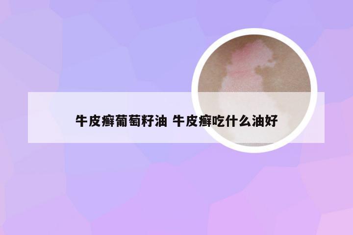 牛皮癣葡萄籽油 牛皮癣吃什么油好