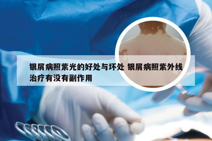银屑病照紫光的好处与坏处 银屑病照紫外线治疗有没有副作用