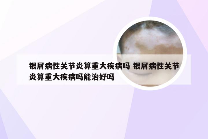 银屑病性关节炎算重大疾病吗 银屑病性关节炎算重大疾病吗能治好吗