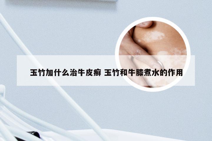 玉竹加什么治牛皮癣 玉竹和牛膝煮水的作用