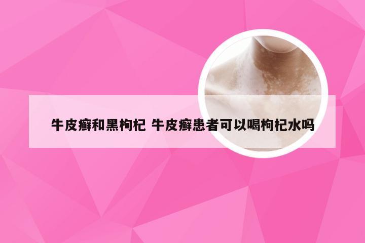 牛皮癣和黑枸杞 牛皮癣患者可以喝枸杞水吗