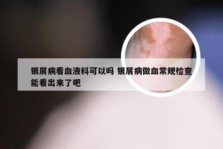 银屑病看血液科可以吗 银屑病做血常规检查能看出来了吧