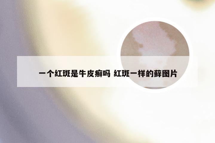 一个红斑是牛皮癣吗 红斑一样的藓图片