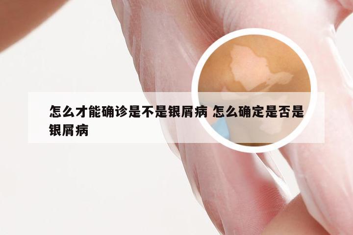怎么才能确诊是不是银屑病 怎么确定是否是银屑病