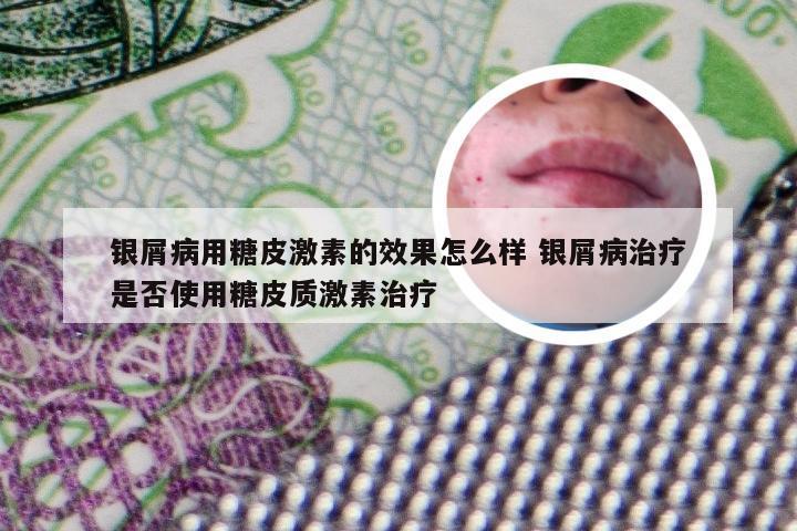 银屑病用糖皮激素的效果怎么样 银屑病治疗是否使用糖皮质激素治疗