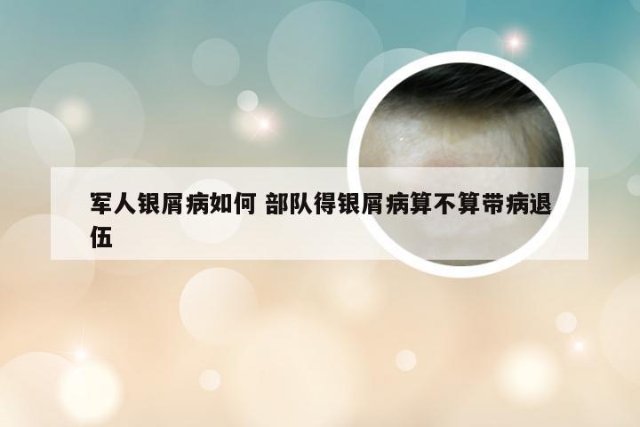 军人银屑病如何 部队得银屑病算不算带病退伍