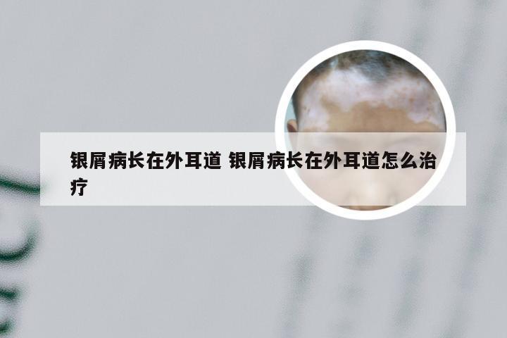 银屑病长在外耳道 银屑病长在外耳道怎么治疗