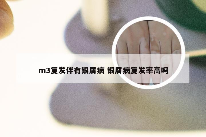 m3复发伴有银屑病 银屑病复发率高吗