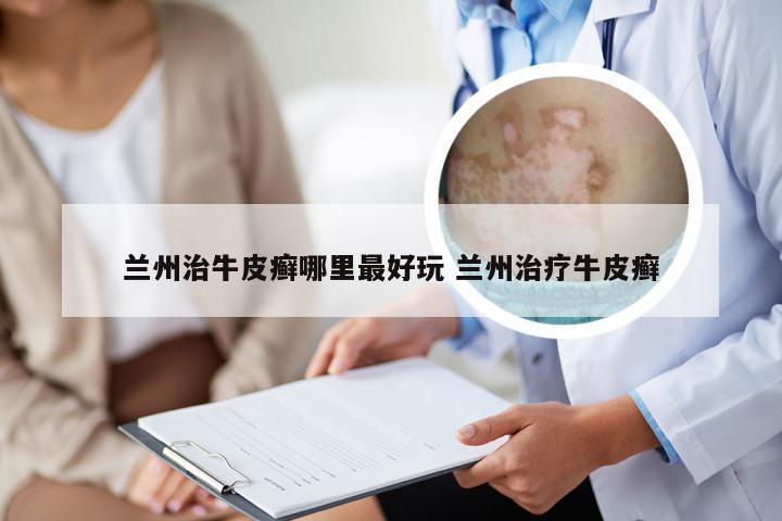 兰州治牛皮癣哪里最好玩 兰州治疗牛皮癣