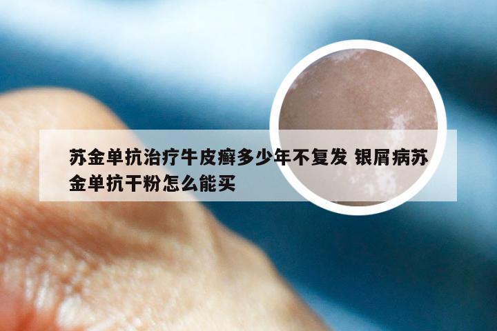 苏金单抗治疗牛皮癣多少年不复发 银屑病苏金单抗干粉怎么能买
