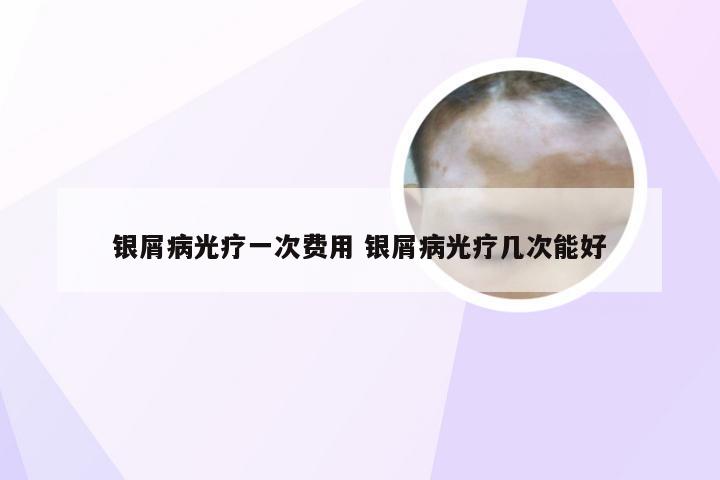 银屑病光疗一次费用 银屑病光疗几次能好