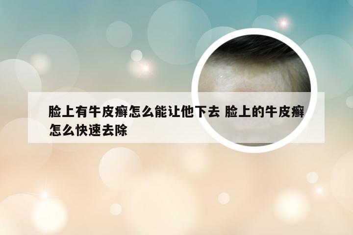 脸上有牛皮癣怎么能让他下去 脸上的牛皮癣怎么快速去除