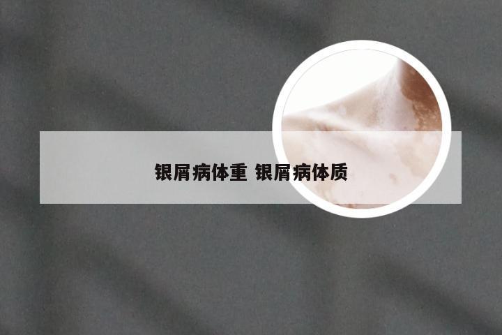 银屑病体重 银屑病体质