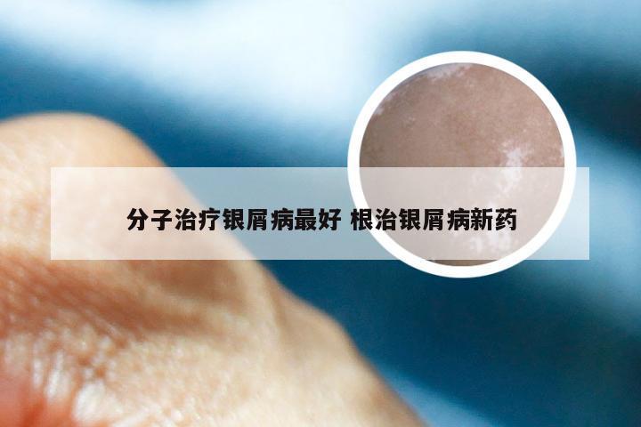 分子治疗银屑病最好 根治银屑病新药