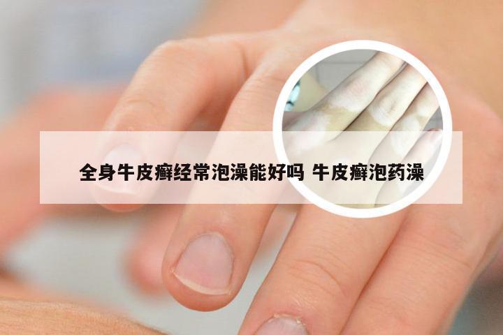 全身牛皮癣经常泡澡能好吗 牛皮癣泡药澡