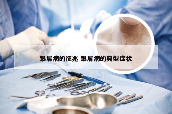 银屑病的征兆 银屑病的典型症状