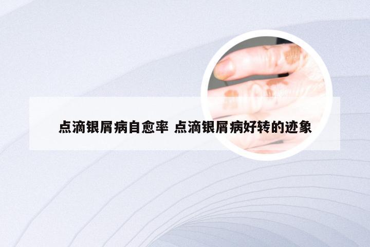 点滴银屑病自愈率 点滴银屑病好转的迹象