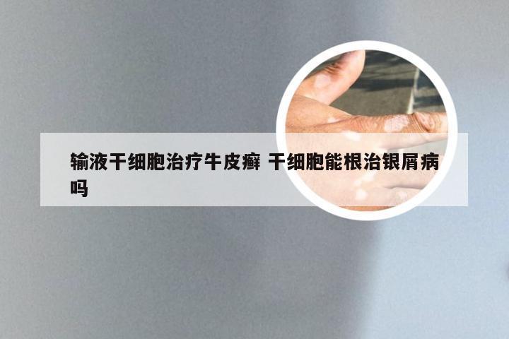 输液干细胞治疗牛皮癣 干细胞能根治银屑病吗