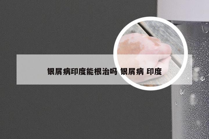 银屑病印度能根治吗 银屑病 印度