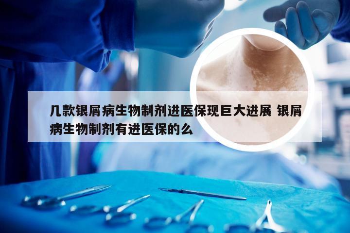 几款银屑病生物制剂进医保现巨大进展 银屑病生物制剂有进医保的么