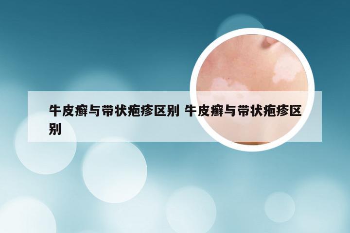 牛皮癣与带状疱疹区别 牛皮癣与带状疱疹区别
