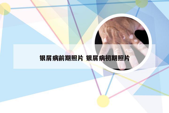 银屑病前期照片 银屑病初期照片