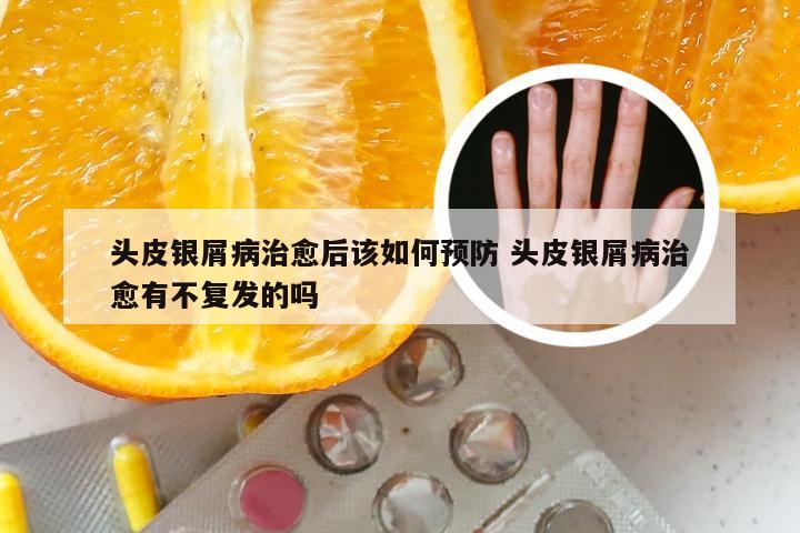 头皮银屑病治愈后该如何预防 头皮银屑病治愈有不复发的吗