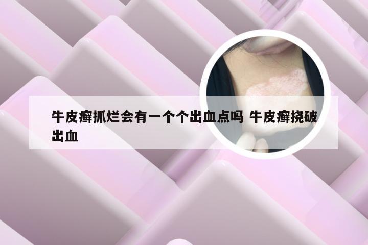牛皮癣抓烂会有一个个出血点吗 牛皮癣挠破出血