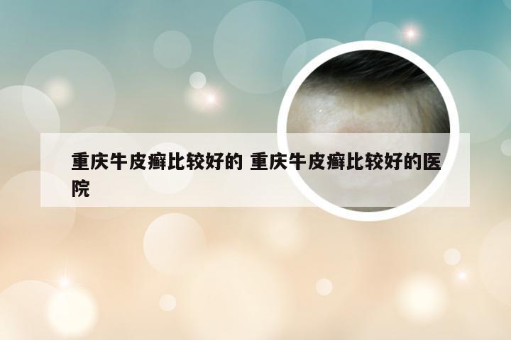 重庆牛皮癣比较好的 重庆牛皮癣比较好的医院