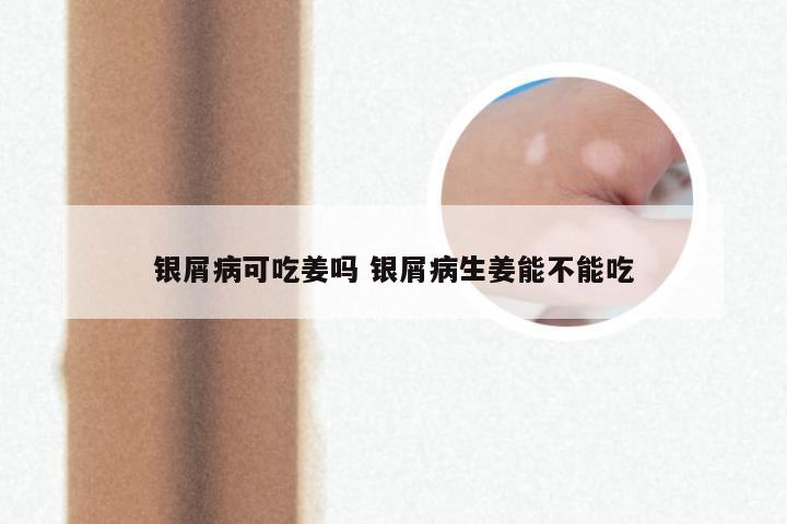 银屑病可吃姜吗 银屑病生姜能不能吃
