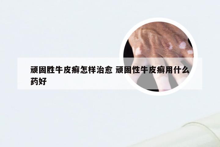 顽固胜牛皮癣怎样治愈 顽固性牛皮癣用什么药好