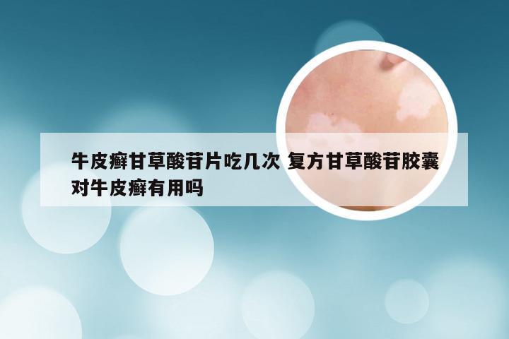 牛皮癣甘草酸苷片吃几次 复方甘草酸苷胶囊对牛皮癣有用吗