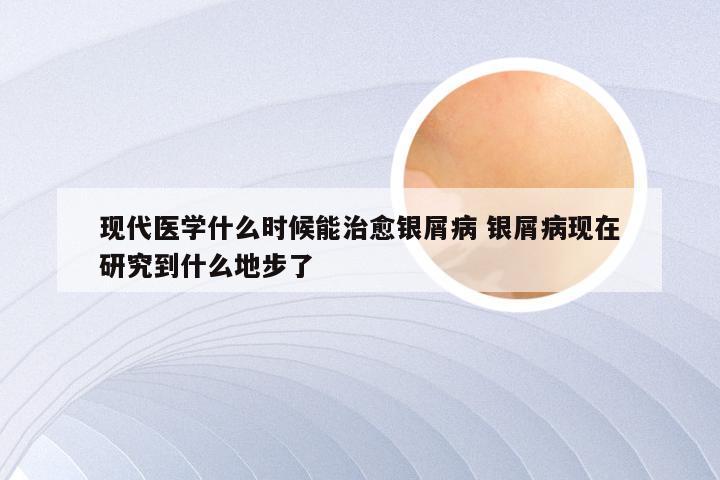 现代医学什么时候能治愈银屑病 银屑病现在研究到什么地步了