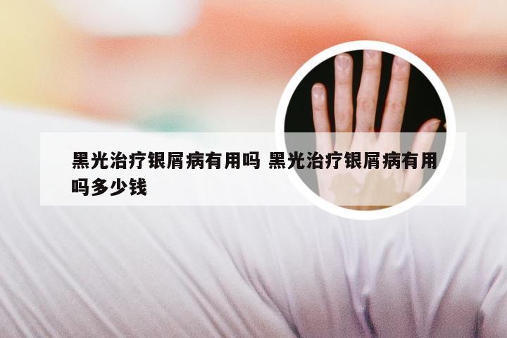 黑光治疗银屑病有用吗 黑光治疗银屑病有用吗多少钱