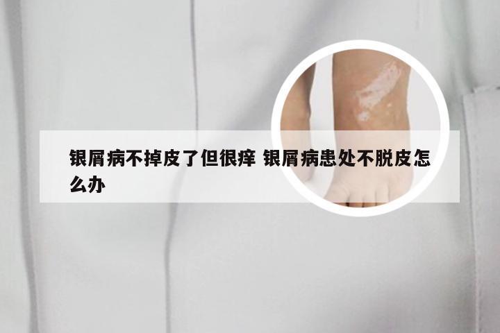 银屑病不掉皮了但很痒 银屑病患处不脱皮怎么办
