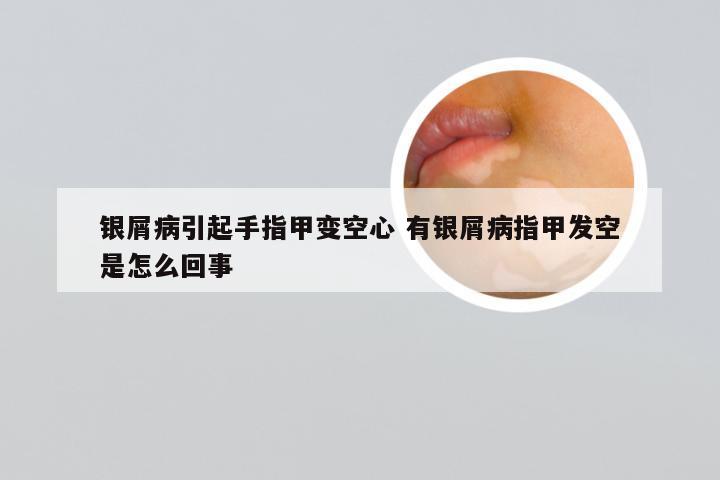 银屑病引起手指甲变空心 有银屑病指甲发空是怎么回事