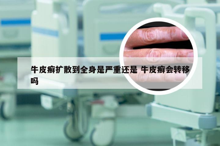牛皮癣扩散到全身是严重还是 牛皮癣会转移吗