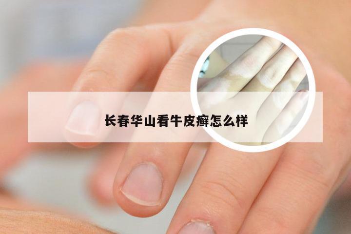 长春华山看牛皮癣怎么样
