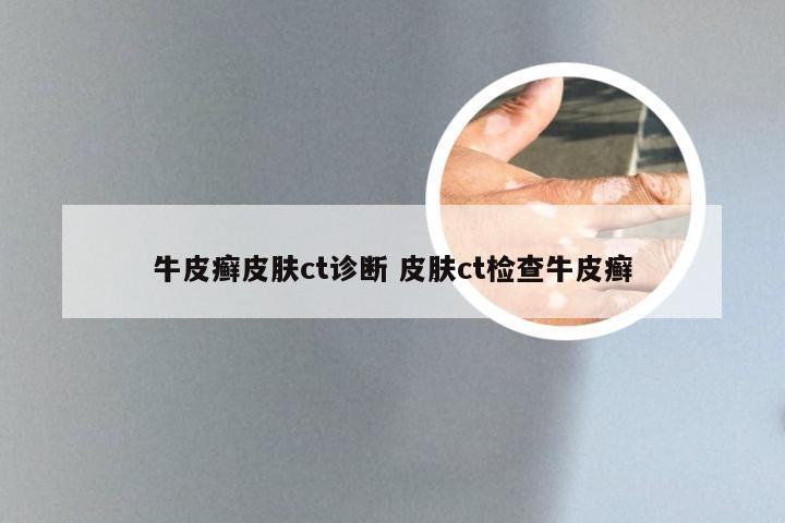 牛皮癣皮肤ct诊断 皮肤ct检查牛皮癣
