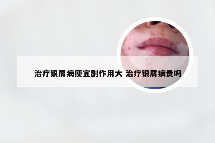 治疗银屑病便宜副作用大 治疗银屑病贵吗