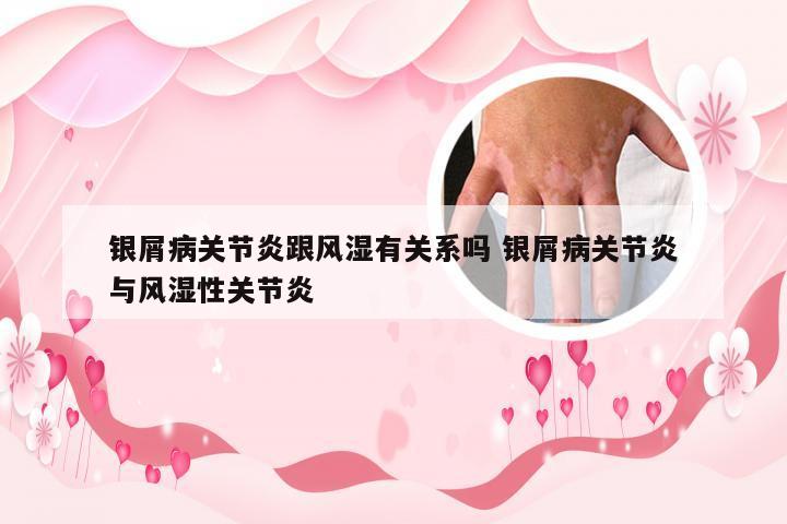银屑病关节炎跟风湿有关系吗 银屑病关节炎与风湿性关节炎